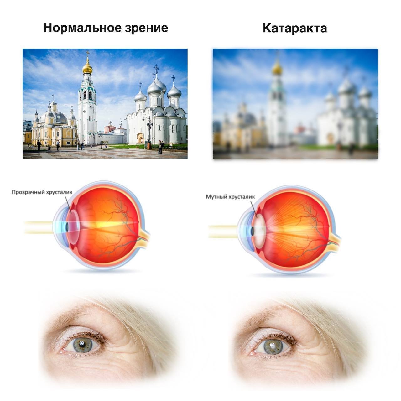 Около четырех тысяч пациентов с катарактой прооперировали в Вологодской областной офтальмологической больнице за 2025 год