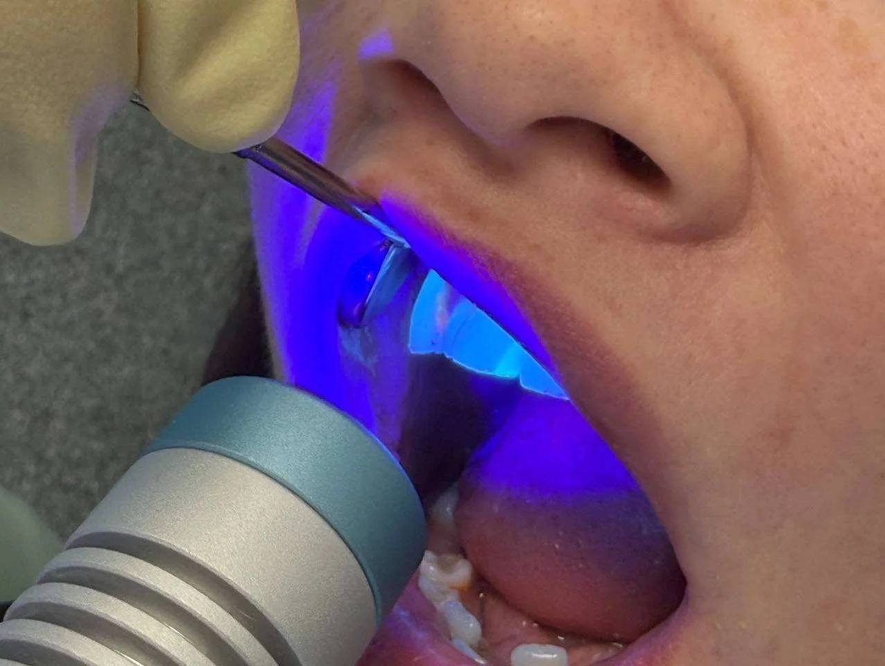 В марте почти 3000 вологжан проверили полость рта на онкологию